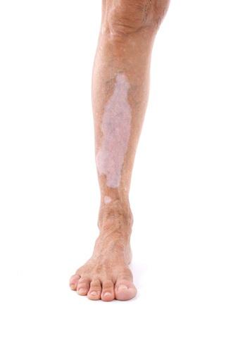 Ginkgo biloba vitiligo